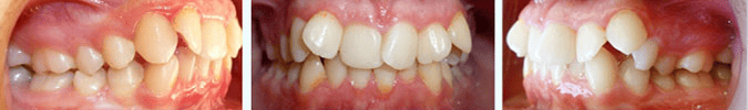 Before orthodontic treatment at Align Orthodontics Lexington