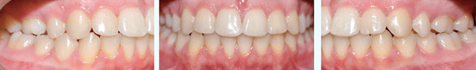 After orthodontic treatment at Align Orthodontics Lexington